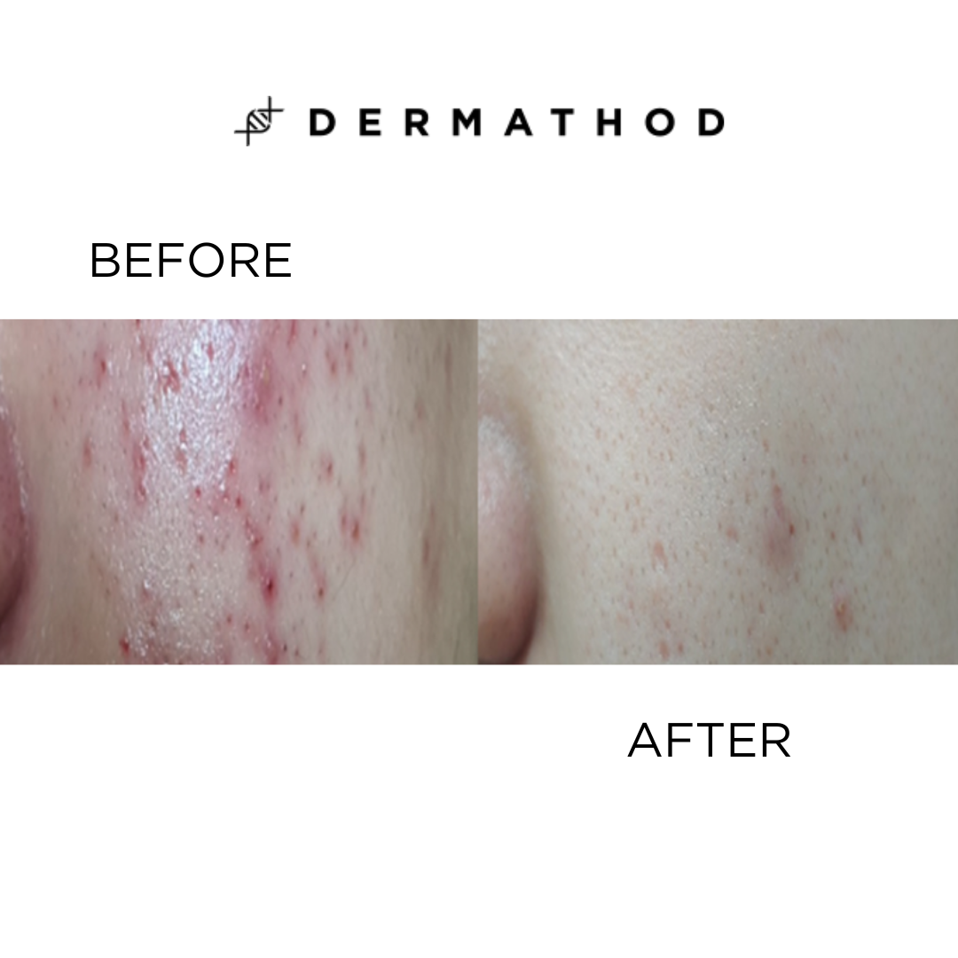 Dermathod Derma Level Latoxin Ampoule