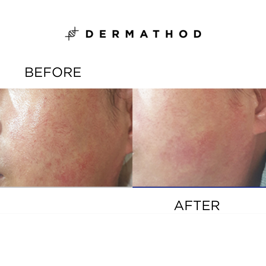 Dermathod Derma Level Latoxin Ampoule