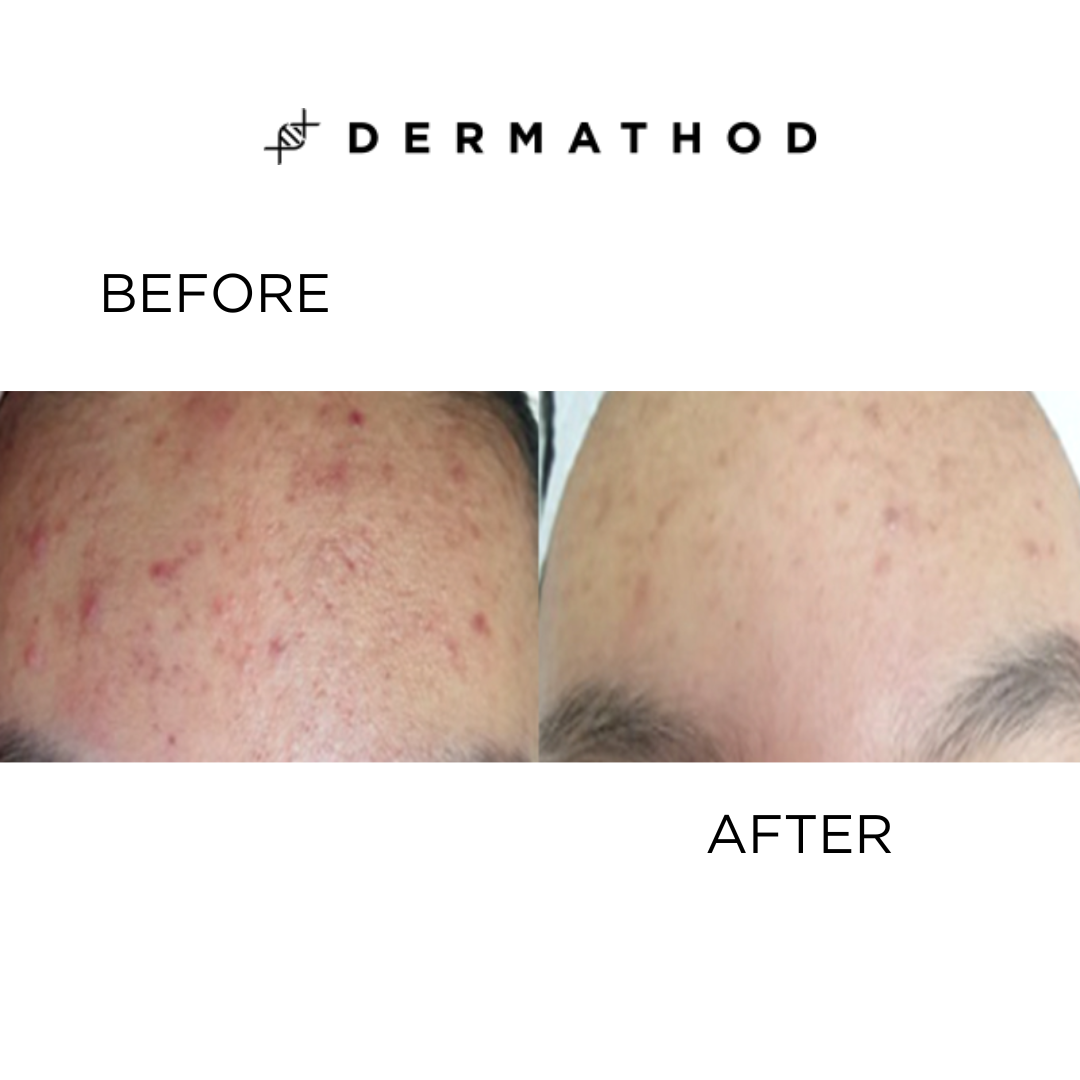 Dermathod Derma Level Latoxin Ampoule