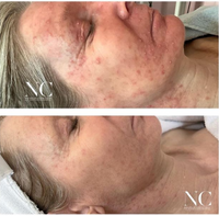 KRX PD 13 Therapy Acne + Rosacea Therapy