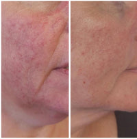 Seoulogy Krx PD 13 Therapy Acne + Rosacea Therapy, professional Korean skincare — view 2