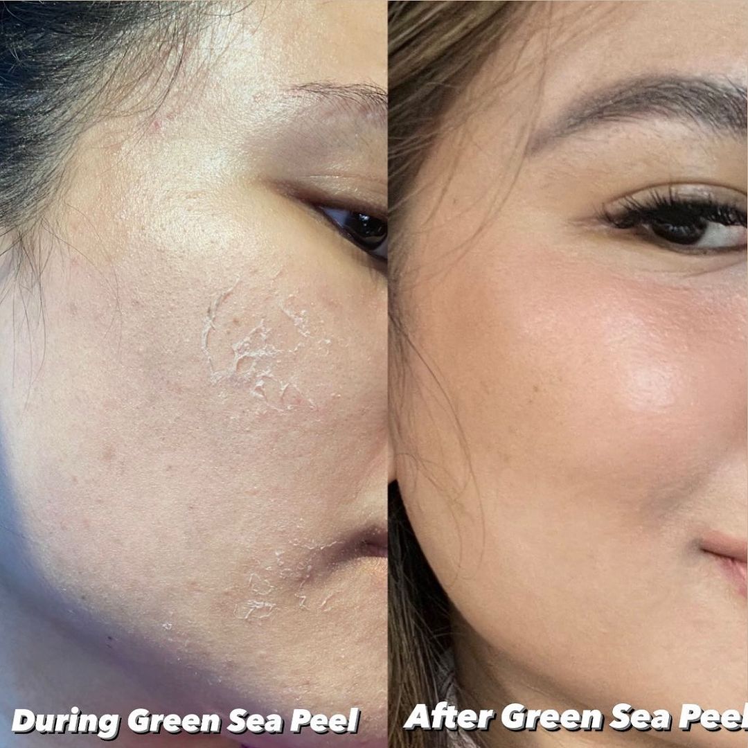 Krx Green Sea Peel