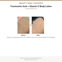 Beauty Body Factorie Tranexamic Acid and Vitamin C Body Lotion before and after results card