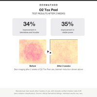 Dermathod O2 Tox Peel test results: 34 percent blemish and 35 percent pore improvement after 2 weeks