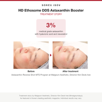 ISOV HD Ethosome DDS Astaxanthin Booster treatment story with before and after photos