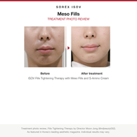 ISOV Meso Fills treatment photo review, Fills Tightening Therapy before and after
