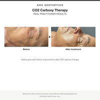 KRX CO2 Carboxy Therapy before and after results card
