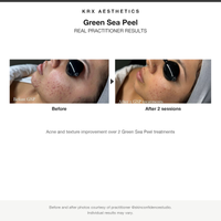 KRX Green Sea Peel before and after results card, acne and texture improvement over 2 sessions