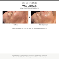 KRX VTox Lift Mask real practitioner before and after results