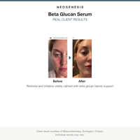 Neogenesis Beta Glucan Serum before and after results card, redness calmed