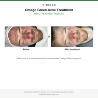 Omelon Omega Green Acne Treatment before and after results card