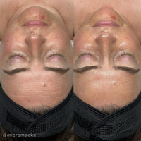 Seoulogy Krx Blue Peel, professional Korean skincare — view 2